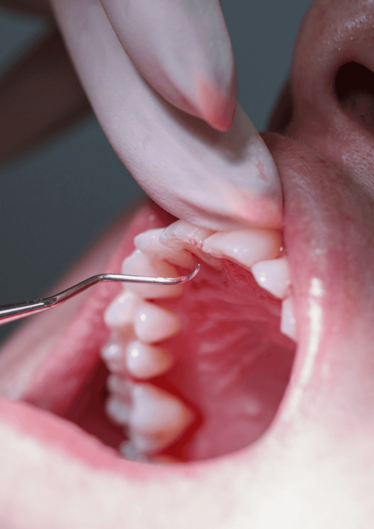 Periodontolog Rzeszów – diagnostyka i&nbsp;leczenie paradontozy – chorób dziąseł i&nbsp;przyzębia